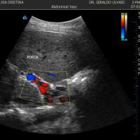 Ecografia doppler de tronco celiaco a color. 882242  Idime