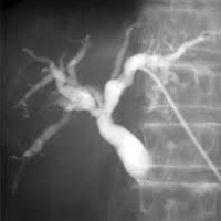 Colangiografia por tubo o cateter en la via biliar. 877602  Idime