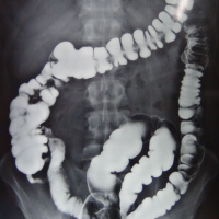 Radiografia de colon por enema con doble contraste. 872105 Idime