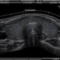 Ecografia de tiroides, cuello. Ecografias Bogota (Mandalay)