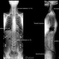 Radiografia panoramica de columna. 871061  Idime