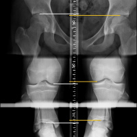 Radiografia para estudio de longitud de los huesos. 873003. Idime