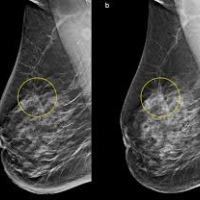 Mamografia bilateral. 876802. Idime. (2024)