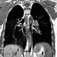 Resonancia nuclear magnetica de torax, proyecciones pa y lateral contrastado. EN. Codigo 883301 SC(2022)
