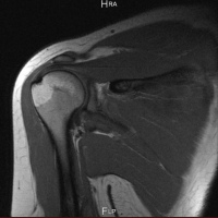 Resonancia nuclear magnetica de miembro superior sin incluir articulaciones.883511 Idime (2022)