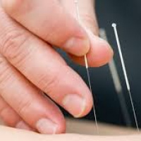 Sesion de acupuntura. Dra. Osorio