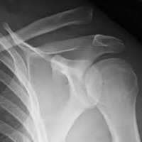 Radiografia de omoplato. 873111  Idime