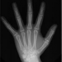 Radiografia para detectar edad osea (carpograma). 873004. Idime
