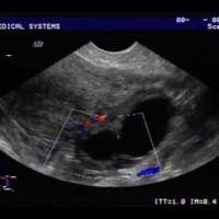 Seguimiento ecografico de ovulacion transvaginal x sesión. Ecografias Bogota (Mandalay)