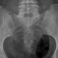 Radiografia de sacro coxis. 871050  Idime