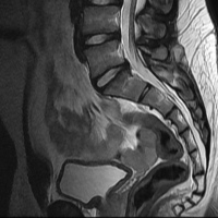 Resonancia nuclear magnetica de columna sacroiliaca con contraste. 883232. Idime