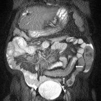 Resonancia nuclear magnetica de intestino delgado. EN. Codigo 883401-10 (2022)
