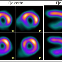 Perfusion miocardica en reposo.920406  Idime (2024)