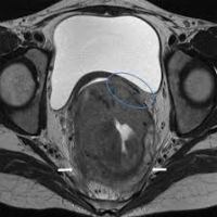 Resonancia nuclear magnetica endorrectal. Idime
