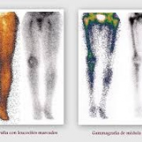 Gamagrafia de medula osea. 920502 Idime (2024)