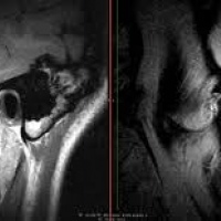 Resonancia nuclear magnetica de articulacion temporomandibular con contraste. 883105. Idime