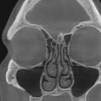 Tomografia axial computada de senos paranasales o cara (cortes axiales y coronales) contrastado, Codigo CUPS. 879131. (2022) Idime