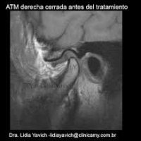 Resonancia nuclear magnetica de articulacion temporomandibular 883105. Idime. (2022)