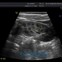 Ecografia de vias urinarias (incluye renal). Ecografias Bogota (Mandalay)