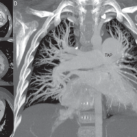 Angiotomografia de arterias pulmonares. 879901. Idime. (2022)