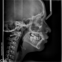 Radiografia de tejidos blandos de cuello.870601 Idime