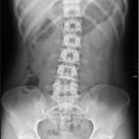 Radiografia de abdomen simple con proyecciones adicionales (serie de abdomen agudo) 872011. Idime. (2024)
