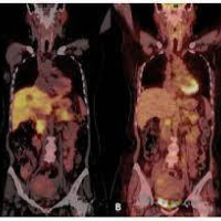 Tomografia por emision de positrones. Unidosis PMSA (PET-CT). 921401  Idime (2024)