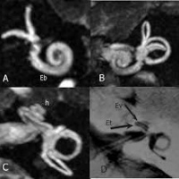 Resonancia nuclear magnetica de oidos. 883109 Idime. (2022)