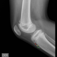 Radiografia de rodilla AP y lateral. 873420 Idime