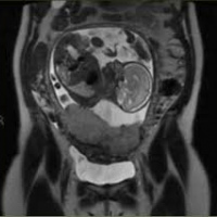Resonancia nuclear magnetica de placenta. 883443. Idime. (2022)