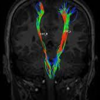 Resonancia nuclear magnetica de cerebro con tractografia simple y contrastada. EN. Codigo CUPS 883106 SC (2022)
