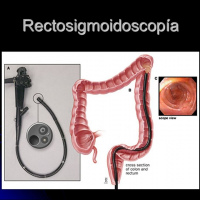 Rectosigmoidoscopia flexible con sedacion.Uniendoscopia (2023)