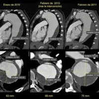 Tomografia computada de vasos. Aorta toracica. 879901   Idime (2024)