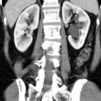 Urografia con nefrotomografia.879431  Idime (2024)