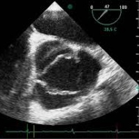 Ecocardiograma de estres con prueba de esfuerzo o con prueba farmacologica. 881210 Idime
