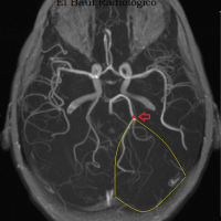 Tomografia computada de vasos. cerebral. 879901   Idime (2024)