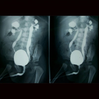 Uretrocistografia miccional. 877862  Idime