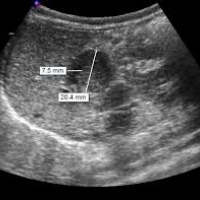 Ecografia de abdomen: piloro. 881313 Idime