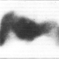 Gamagrafia hepatoesplenica. 920701  Idime (2024)