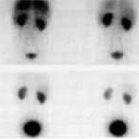 Gamagrafia de filtracion glomerular. 920805  Idime (2024)
